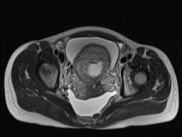 Closed loop small bowel obstruction in pregnancy (MRI) (Radiopaedia 87637-104031 D 32).jpg