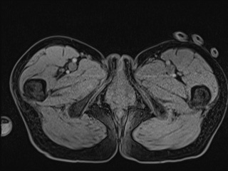 Closed loop small bowel obstruction in pregnancy (MRI) (Radiopaedia 87637-104031 G 40).jpg