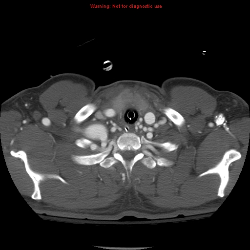 File:Coarctation of the aorta (Radiopaedia 8681-9490 B 9).jpg