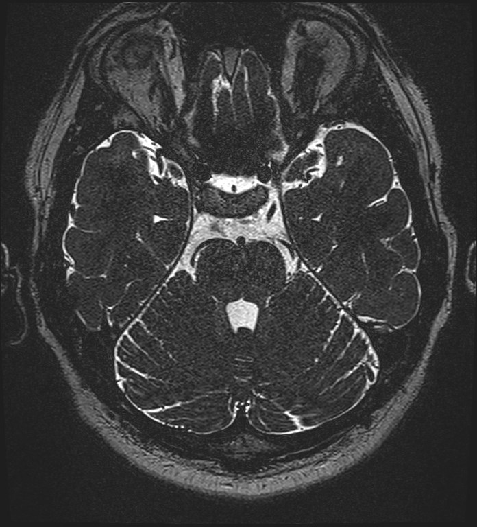 Cochlear incomplete partition type III associated with hypothalamic hamartoma (Radiopaedia 88756-105498 Axial T2 114).jpg
