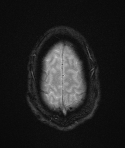 File:Colloid cyst (Radiopaedia 44510-48181 Axial Gradient Echo 24).png