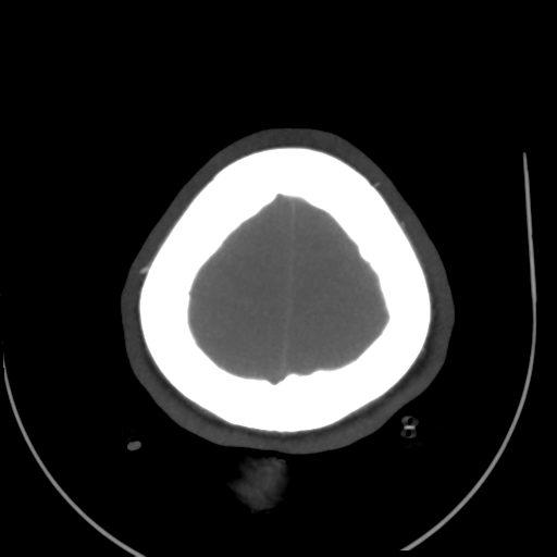 Colloid cyst (resulting in death) (Radiopaedia 33423-34499 A 52).png