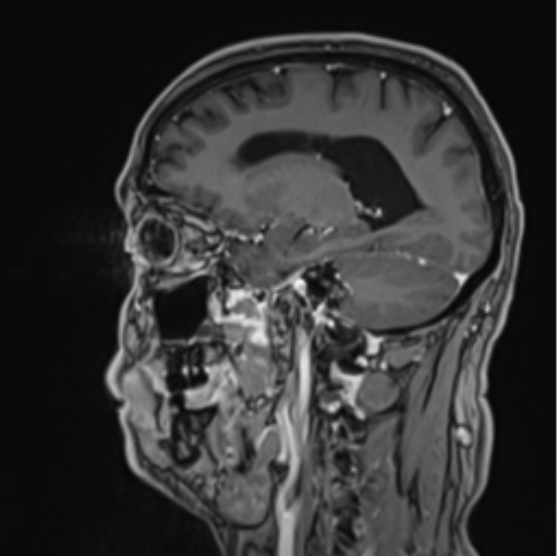 File:Colloid cyst of the third ventricle (Radiopaedia 86571-102662 Sagittal T1 C+ 27).png