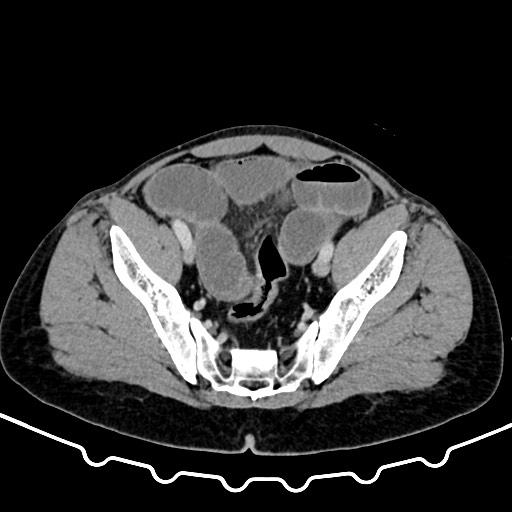 Colocolic intussusception due to large lipoma (Radiopaedia 68773-78482 A 159).jpg