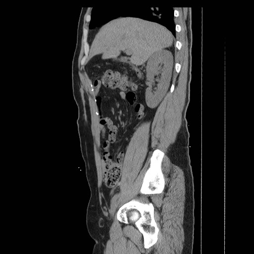 File:Colocutaneous fistula in Crohn's disease (Radiopaedia 29586-30093 C 8).jpg