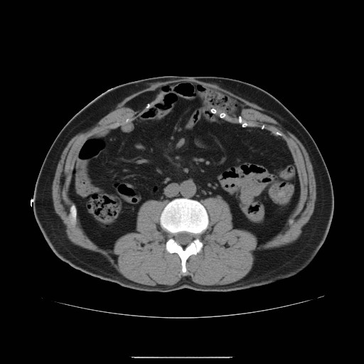 File:Colocutaneous fistula in Crohn's disease (Radiopaedia 29586-30093 D 4).jpg