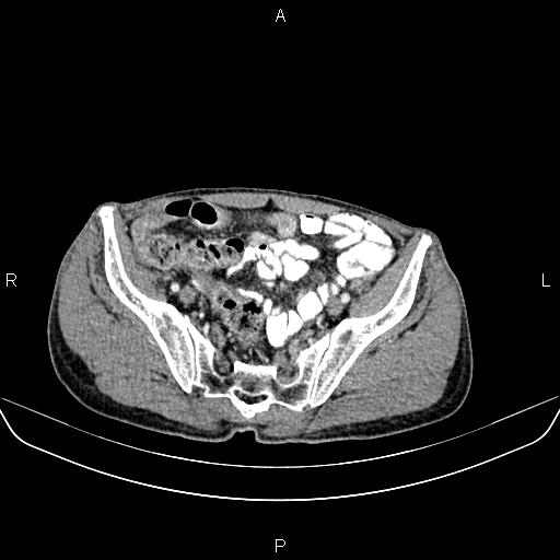 Colon adenocarcinoma - hepatic flexure (Radiopaedia 85635-101395 A 77).jpg
