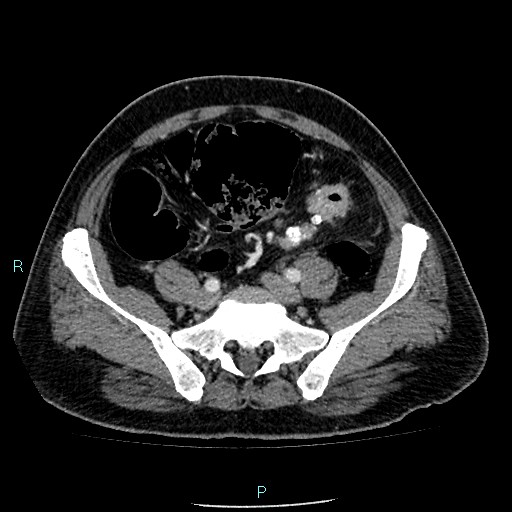 Colon adenocarcinoma with calcific liver metastasis (Radiopaedia 55745-62300 B 33).jpg