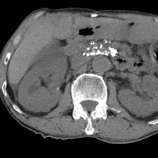Colon cancer with calcified liver metastasis (Radiopaedia 74423-85309 Axial non-contrast 37).jpg