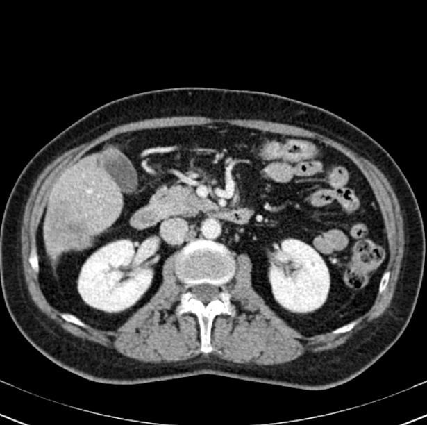 Colon carcinoma with hepatic metastases (Radiopaedia 29477-29961 A 47).jpg