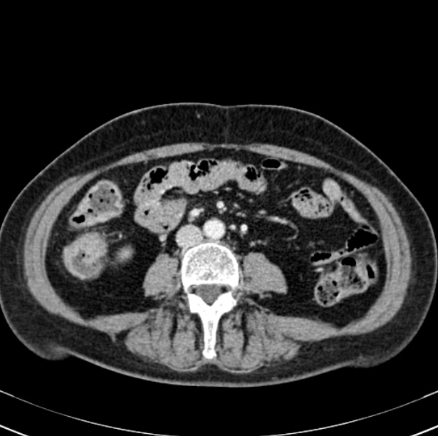 Colon carcinoma with hepatic metastases (Radiopaedia 29477-29961 A 64).jpg