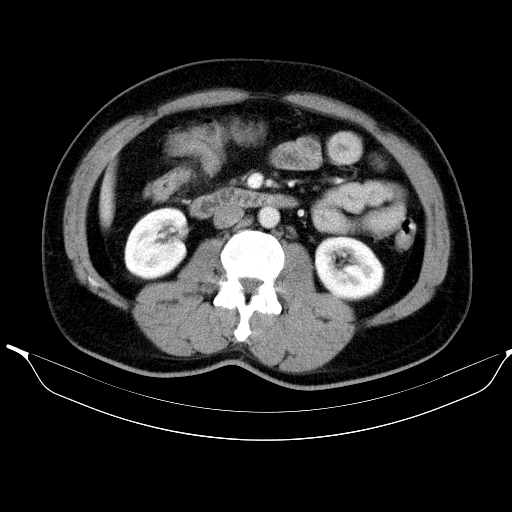 Colonic lipoma with colo-colic intussusception (Radiopaedia 58944-66200 A 30).jpg