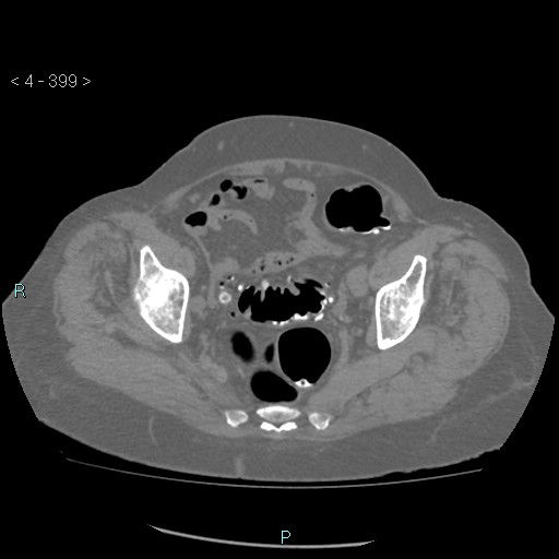 Colonic lipomas (Radiopaedia 49137-54244 Axial bone window 177).jpg