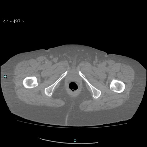 Colonic lipomas (Radiopaedia 49137-54244 Axial bone window 221).jpg