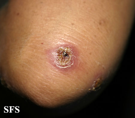 File:Impetigo (Dermatology Atlas 47).jpg