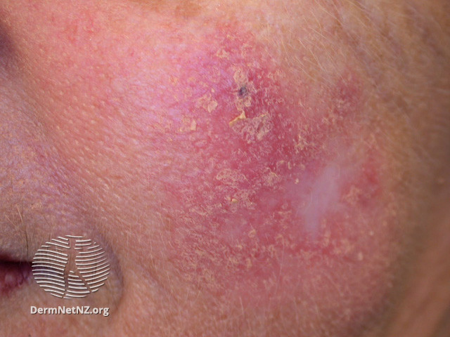 File:Intraepidermal carcinoma (DermNet NZ lesions-scc-in-situ-2940).jpg