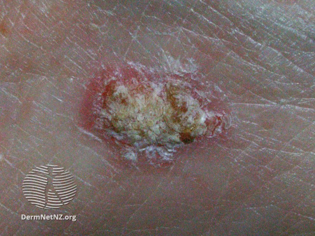 File:Intraepidermal carcinoma (DermNet NZ lesions-scc-in-situ-2951).jpg
