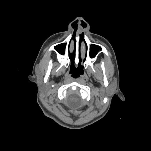 Nasal pyogenic granuloma (lobular capillary hemangioma) (Radiopaedia 85536-101244 Axial non-contrast 11).jpg