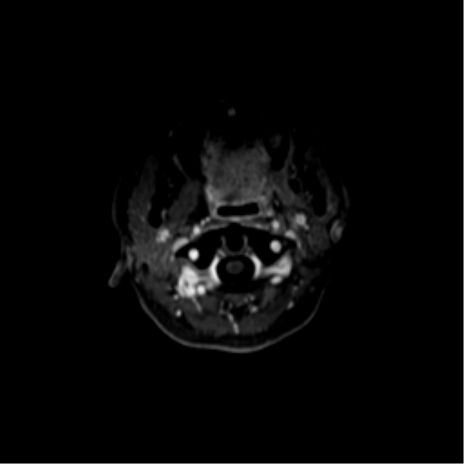 File:Nasopharyngeal carcinoma with cerebral abscess (Radiopaedia 43018-46274 Axial T1 C+ fat sat 4).png