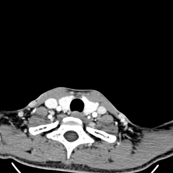 Nasopharyngeal carcinoma with skull base invasion (Radiopaedia 53415-59705 A 180).jpg