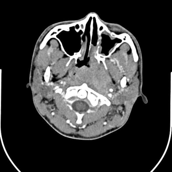 Nasopharyngeal carcinoma with skull base invasion (Radiopaedia 53415-59705 A 51).jpg