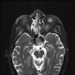 File:Nasopharyngeal carcinoma with skull base invasion (Radiopaedia 59258-66600 D 8).jpg
