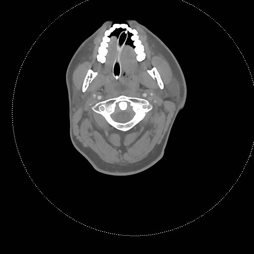 Neck CT angiogram (intraosseous vascular access) (Radiopaedia 55481-61945 B 228).jpg