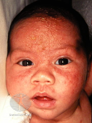 File:Neonatal cephalic pustulosis (DermNet NZ acne-neonatal-acne3).jpg