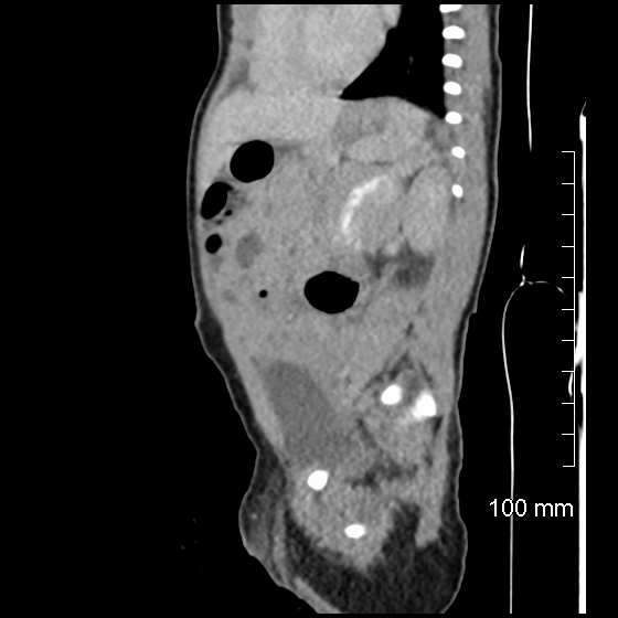 File:Neonatal neuroblastoma (Radiopaedia 56651-63438 C 37).jpg