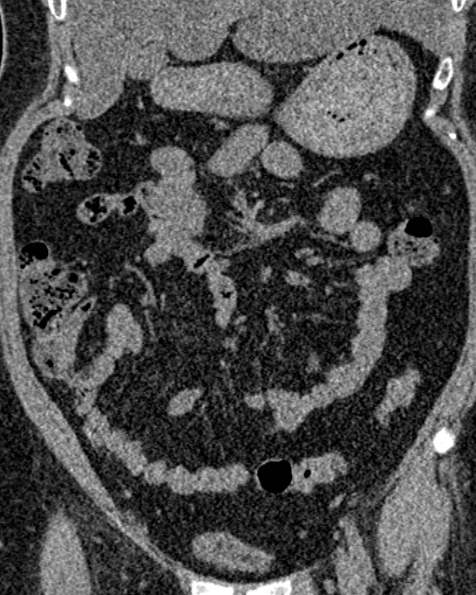 File:Nephrostomy for urosepsis (Radiopaedia 26180-26330 non-contrast 32).jpg