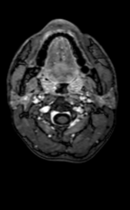 Neuro-Behçet disease (Radiopaedia 90112-107294 Axial T1 C+ 227).jpg