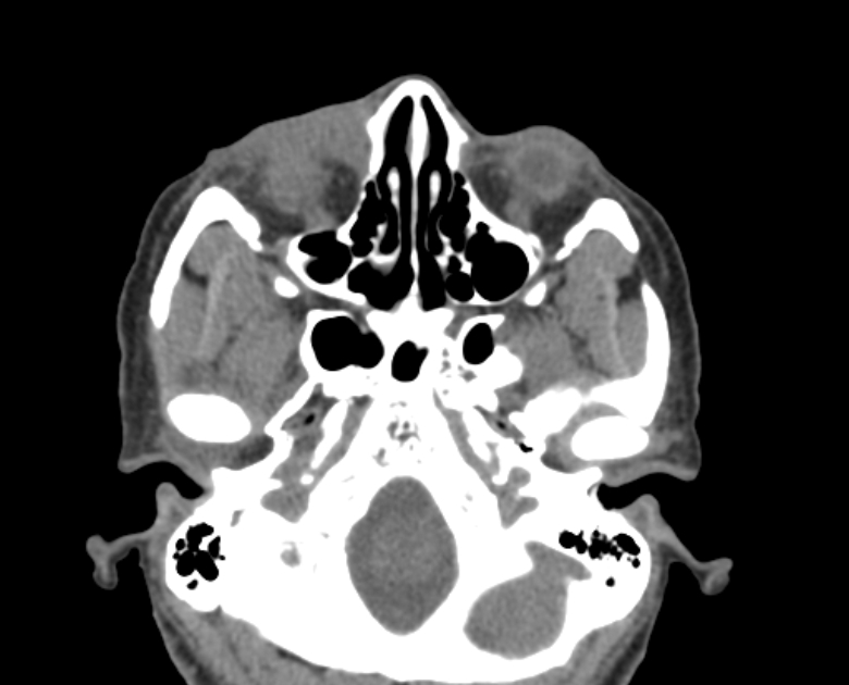 Neurofibromatosis type 1- orbital manifestations (Radiopaedia 49391-54511 Axial non-contrast 37).jpg