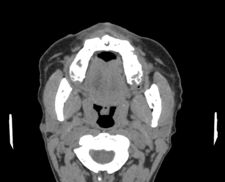 Neurofibromatosis type 1- orbital manifestations (Radiopaedia 49391-54511 Axial non-contrast 5).jpg