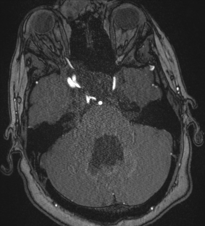 Neurofibromatosis type 1 - head and neck - CNS manifestations (Radiopaedia 49910-55188 Axial MRA 19).png
