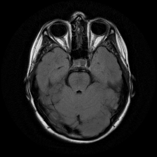 File:Neurofibromatosis type 2 (Radiopaedia 45229-49244 Axial FLAIR 6).png