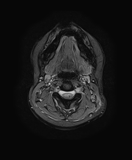 File:Neurofibromatosis type 2 (Radiopaedia 66211-75401 Axial Gradient Echo 1).jpg