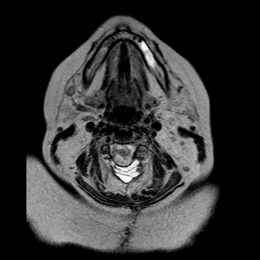 File:Neurofibromatosis type 2 (Radiopaedia 8713-9518 Axial T2 29).jpg