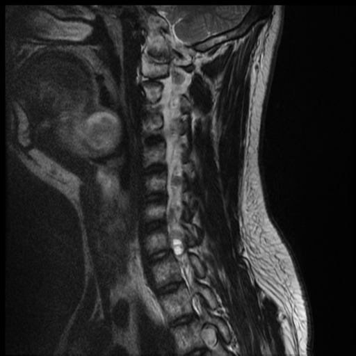 File:Neurofibromatosis type 2 (spinal manifestations) (Radiopaedia 53943-60070 Sagittal T2 9).png