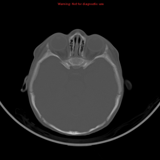 File:Non-accidental injury - bilateral subdural with acute blood (Radiopaedia 10236-10765 Axial bone window 8).jpg