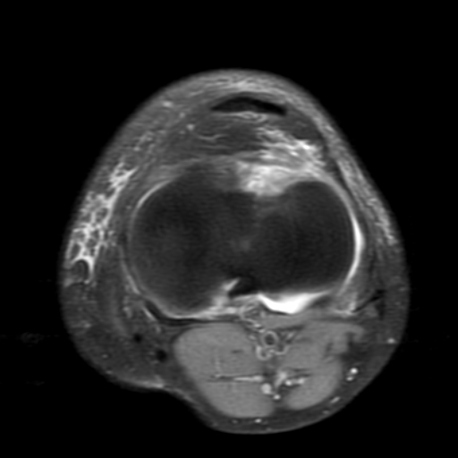 File:Non-displaced patella fracture (Radiopaedia 15932-15582 Axial PD fat sat 17).jpg