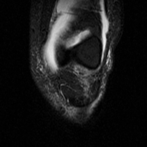 File:Non-displaced patella fracture (Radiopaedia 15932-15582 Coronal STIR 6).jpg