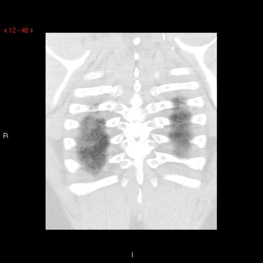 File:Non-specific interstitial pneumonitis (Radiopaedia 27044-27222 Coronal lung window 48).jpg