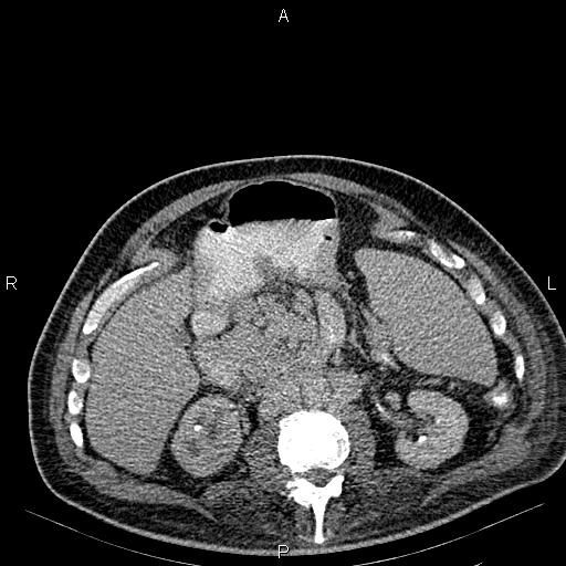 Non Hodgkin lymphoma in a patient with ankylosing spondylitis (Radiopaedia 84323-99621 Axial C+ delayed 30).jpg