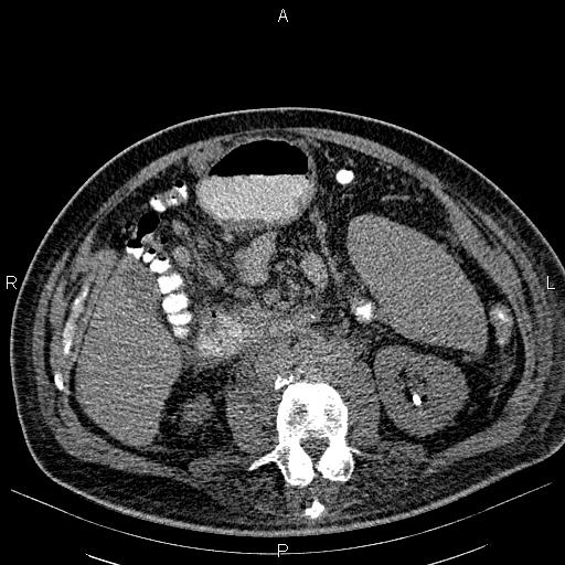 File:Non Hodgkin lymphoma in a patient with ankylosing spondylitis (Radiopaedia 84323-99621 Axial non-contrast 38).jpg