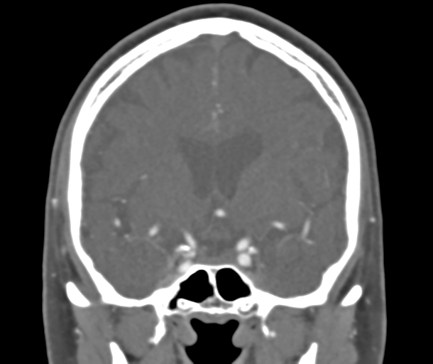 File:Normal CTA head (Radiopaedia 40801-43464 B 43).png