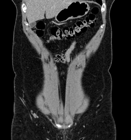 File:Normal CT intravenous urogram (Radiopaedia 39444-41759 A 193).jpg