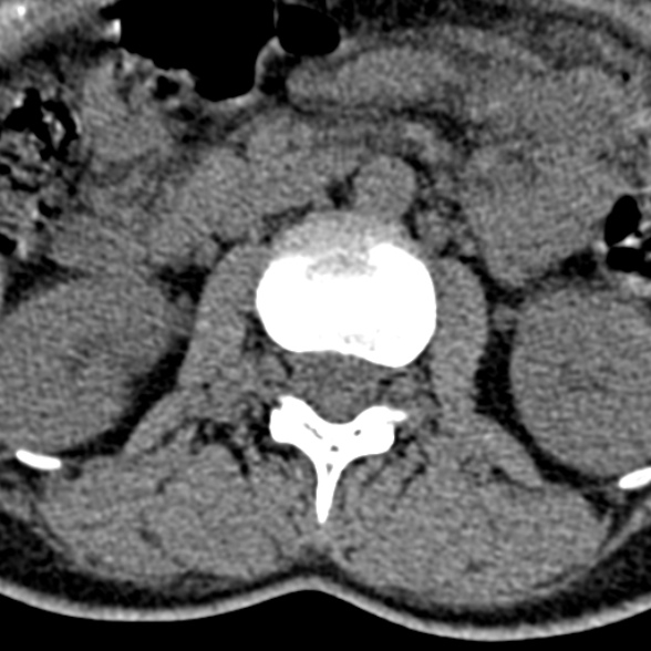 Normal CT lumbar spine (Radiopaedia 53981-60118 Axial non-contrast 36).jpg