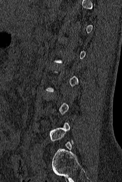File:Normal CT lumbar spine (Radiopaedia 53981-60118 Sagittal bone window 70).jpg