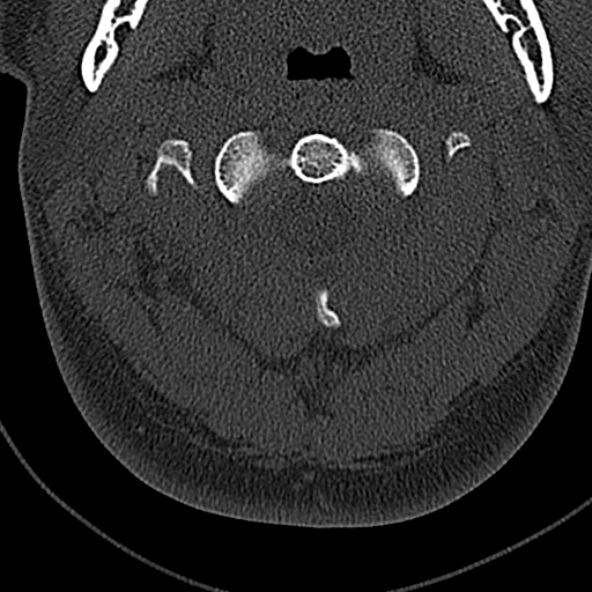 File:Normal CT of the cervical spine (Radiopaedia 53322-59305 Axial bone window 69).jpg