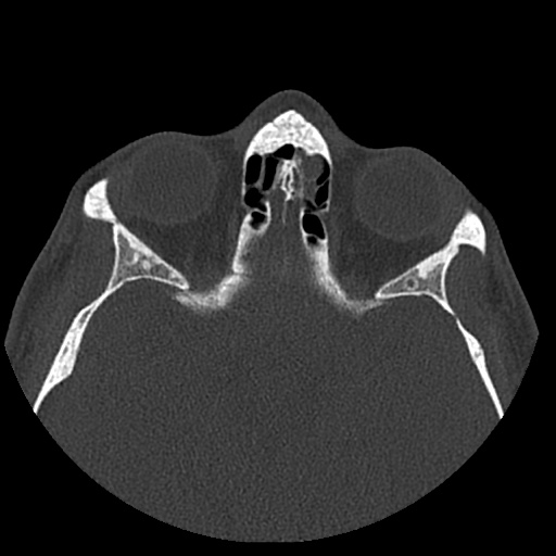 Normal CT paranasal sinuses (Radiopaedia 42286-45390 Axial bone window 39).jpg